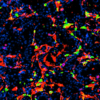 Nanoparticelle efficaci contro il tumore della prostata, uccidono le cellule – Biotech